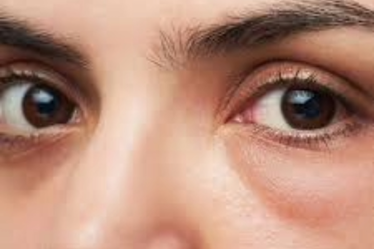 Puffy Under-Eyes / Fluid Retention